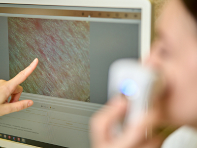 Шрамы (рубцовые изменения, келоидный рубец) - Санаторий и курорт "СИБИРЬ", Тюмень